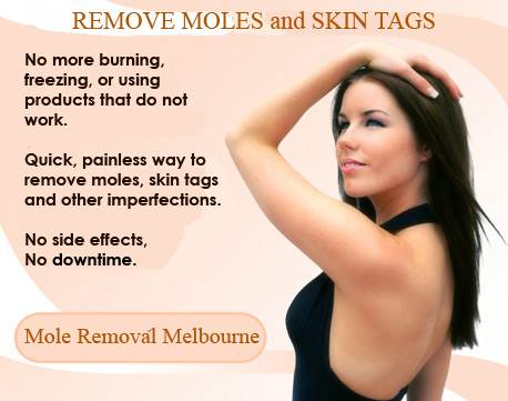 mole removal